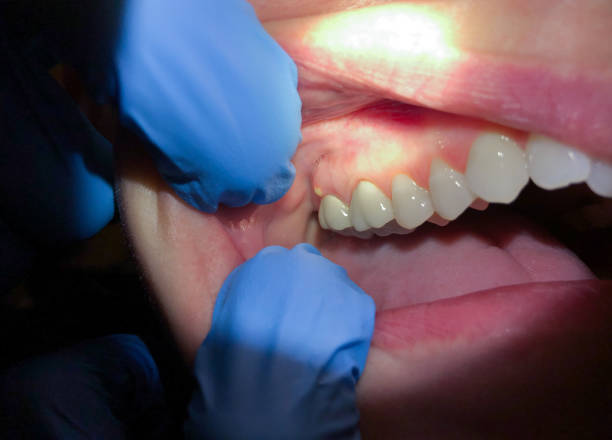 Best Emergency Dentist for Knocked-Out Tooth in Iva, SC
